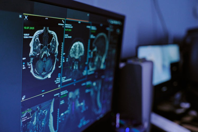 computer screen showing an MRI scan