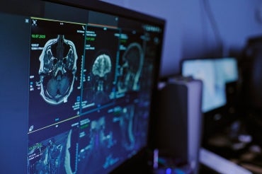 computer screen showing an MRI scan