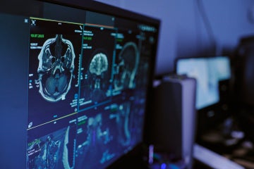 computer screen showing an MRI scan